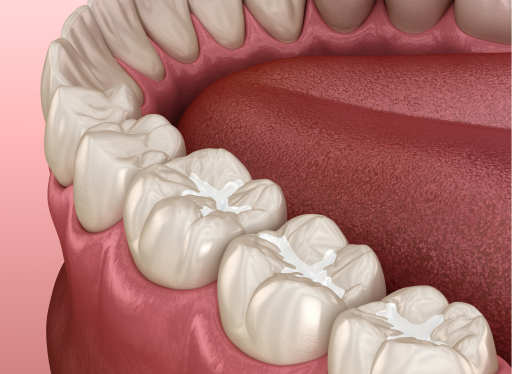 dental sealants diagram