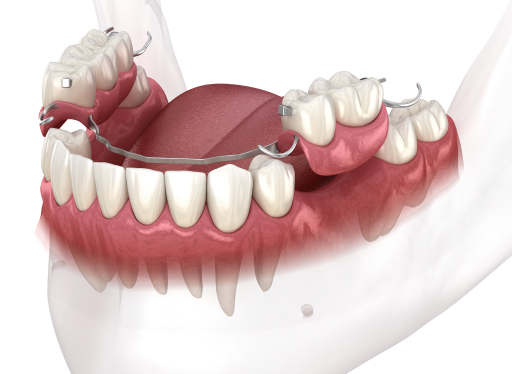dentures diagram